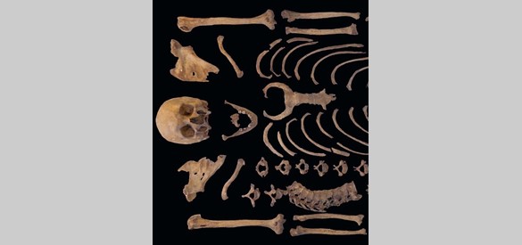 Eerste gedeelte van het skelet van een oude man (60+) met ernstige vergroeiingen